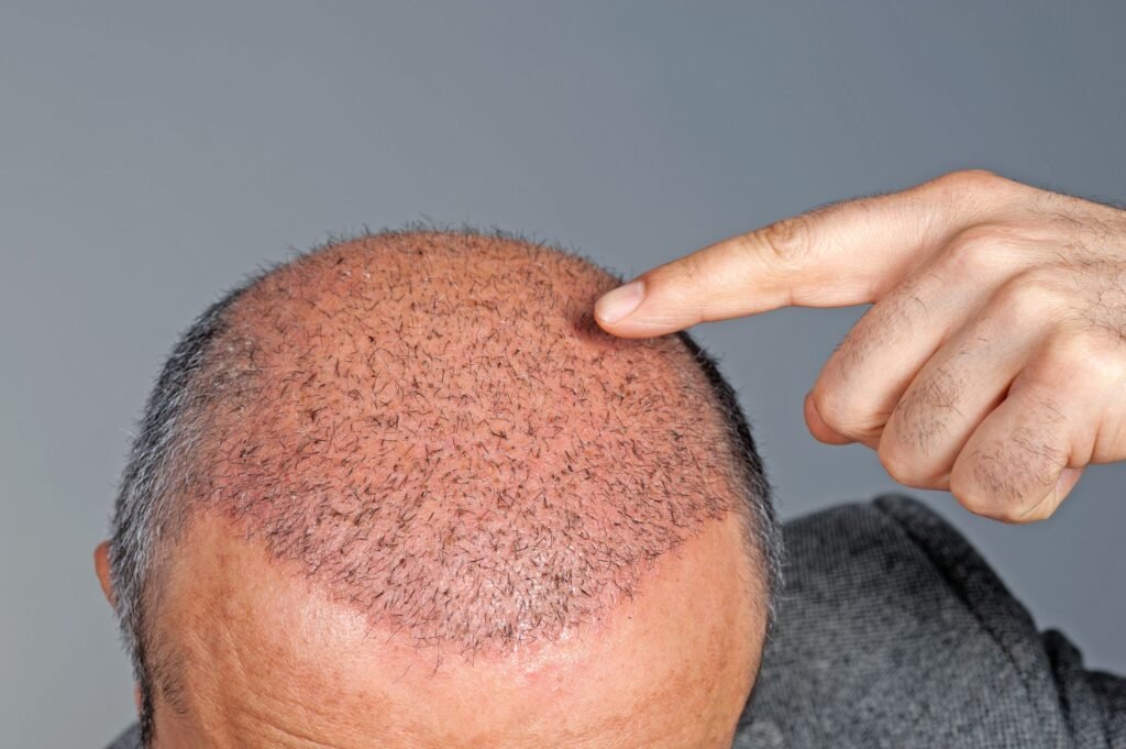 complication and treatment in hair transplant